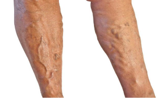 Behandeling van spataderen in de benen