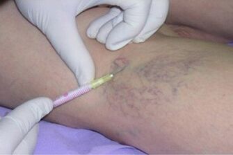 sclerotherapie als methode om spataderen te behandelen