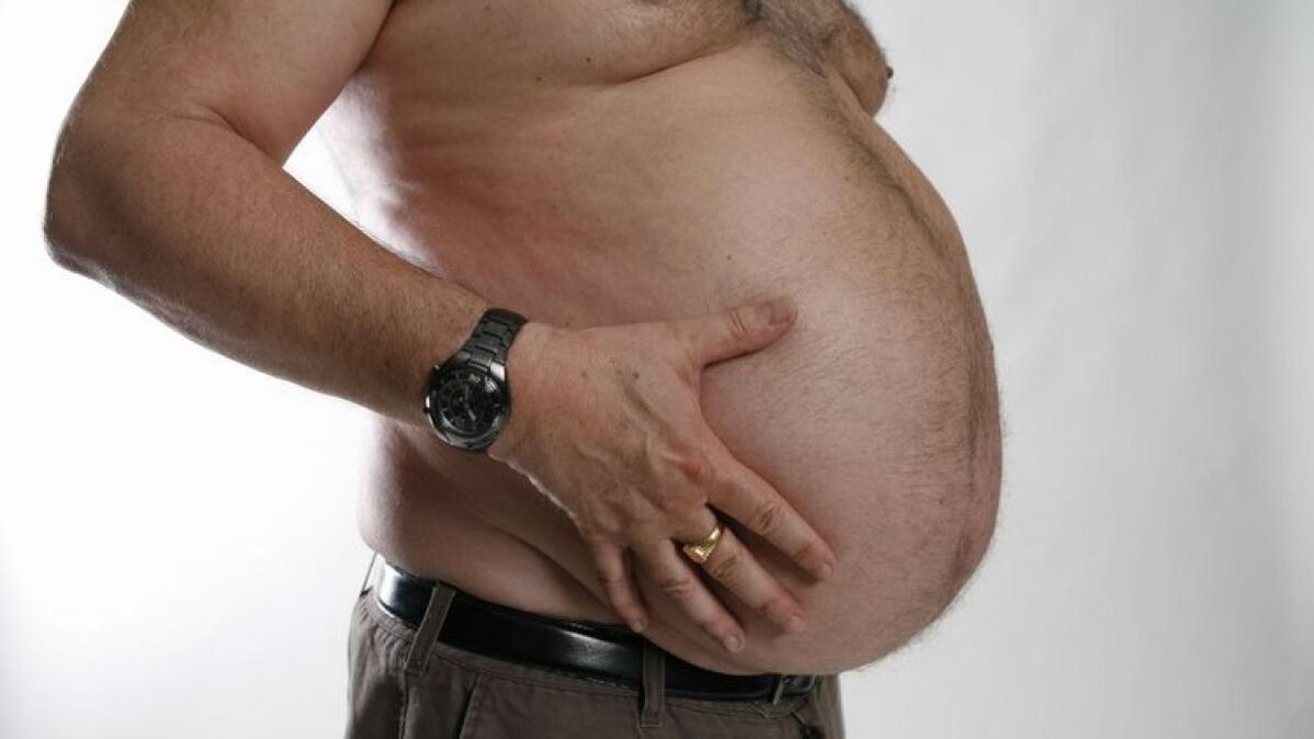 obesitas als oorzaak van de ontwikkeling van spataderen