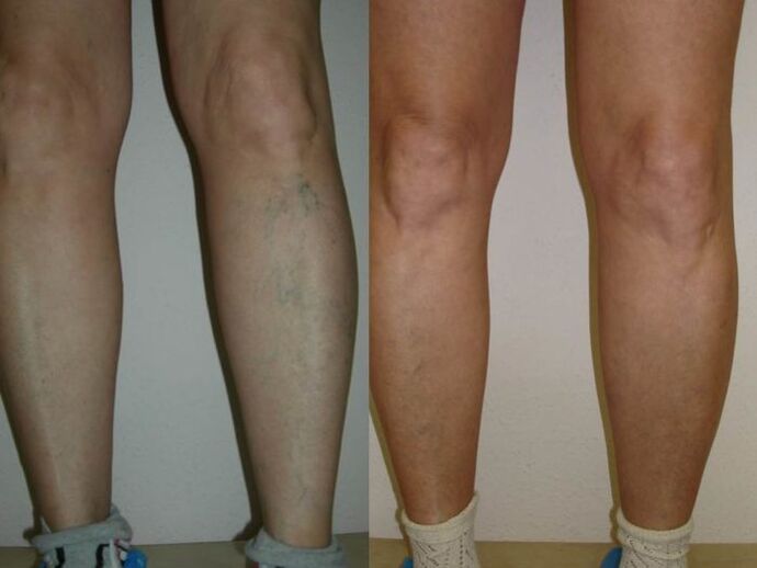 benen voor en na laserbehandeling van spataderen