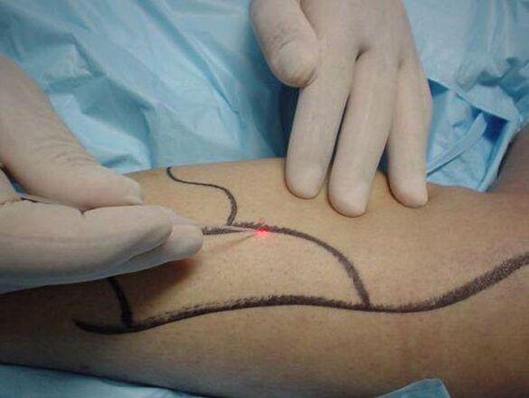 laserbehandeling van spataderen