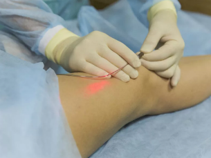 Behandeling van spataderen laser