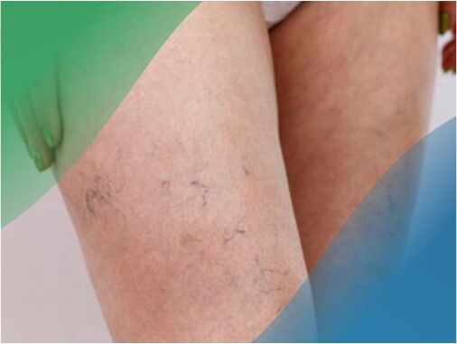 Het vasculaire netwerk op de benen is een van de symptomen van spataderen