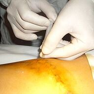 Miniflebectomie is de meest cosmetische behandeling voor spataderen