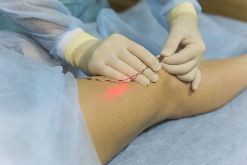 Laserbehandeling van spataderen van de onderste ledematen