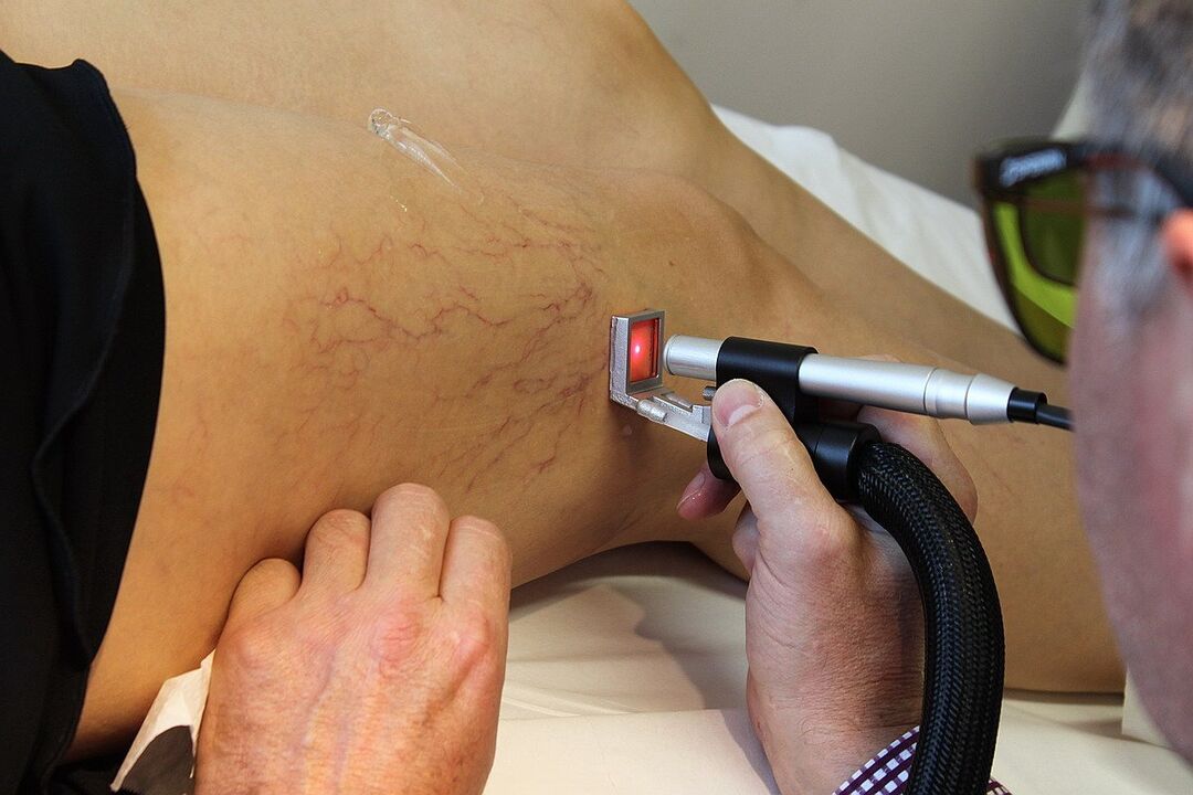 Laser coagulatie