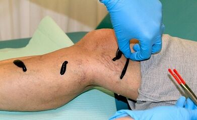 Hirudotherapie voor spataderen