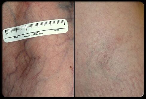 Voor en na de lasertherapieprocedure