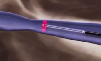 Thermische behandelingen